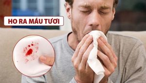 Dấu hiệu nhận biết bệnh lao phổi là gì?