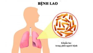 Nguyên nhân gây bệnh lao phổi là gì?