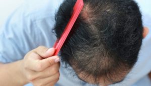 Nguyên nhân gây rụng tóc ở người già